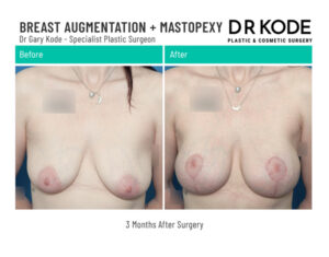 Dr Gary Kode Breast Augmentation - BAM2-Breast-Augmentation-Mastopexy-Dr-Gary-Kode-Front