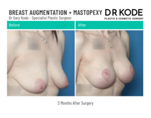 Dr Gary Kode Breast Augmentation - B3-BL-Breast-Augmentation-Mastopexy-Dr-Gary-Kode-45R