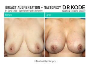 Dr Gary Kode Breast Augmentation - B5-BL-Breast-Augmentation-Mastopexy-Dr-Gary-Kode-Front