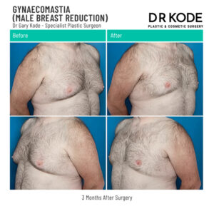 Dr Gary Kode Gynaecomastia Surgery - Gyno1-Gynaecomastia-Male-Breast--Reduction-Dr-Gary-Kode-Front and 45L