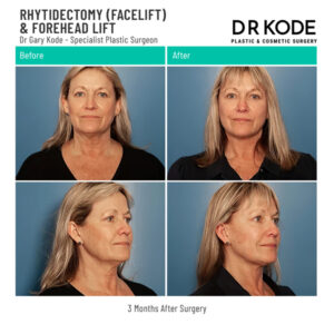Mr Gary Kode Facelift - P3-Facelift_Forehead-Lift-Dr-Mark-Kode