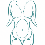 Body Liposuction - Gary Kode Images