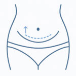 abdominoplasty - Mr. Gary Kode
