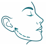 Face Lift - Image Gary Kode
