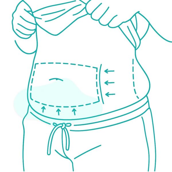 Extended Abdomnoplasty- image Dr. Gary Kode
