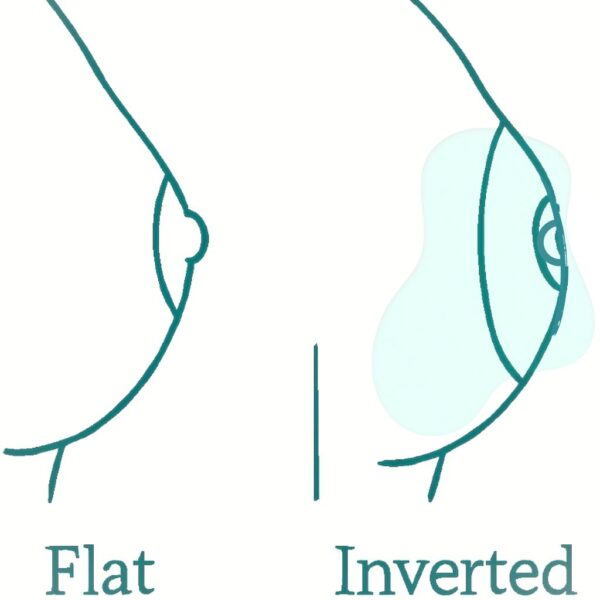 Inverted nipples - Gary Kode